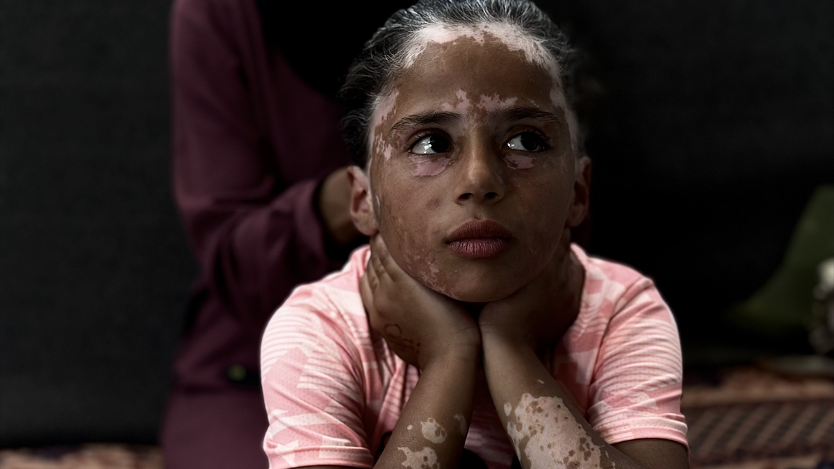 Gazzeli Lana, İsrail korkusu yüzünden vitiligo hastalığına yakalandı